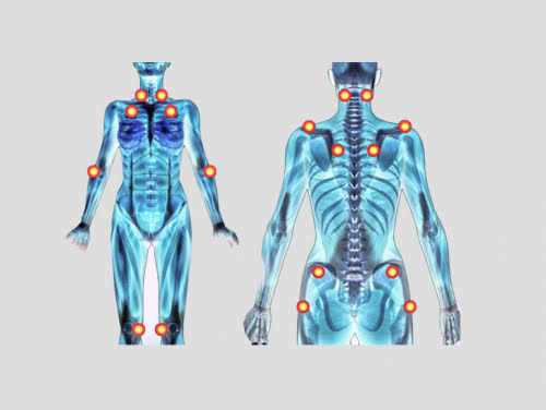 Miyalji (Kas Romatizması) Nedir?